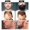 Beard Derma Roller Image 5